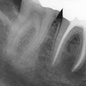 Einzelzahnaufnahme zur Beurteilung der Zahnwurzel und der Wurzelfüllung